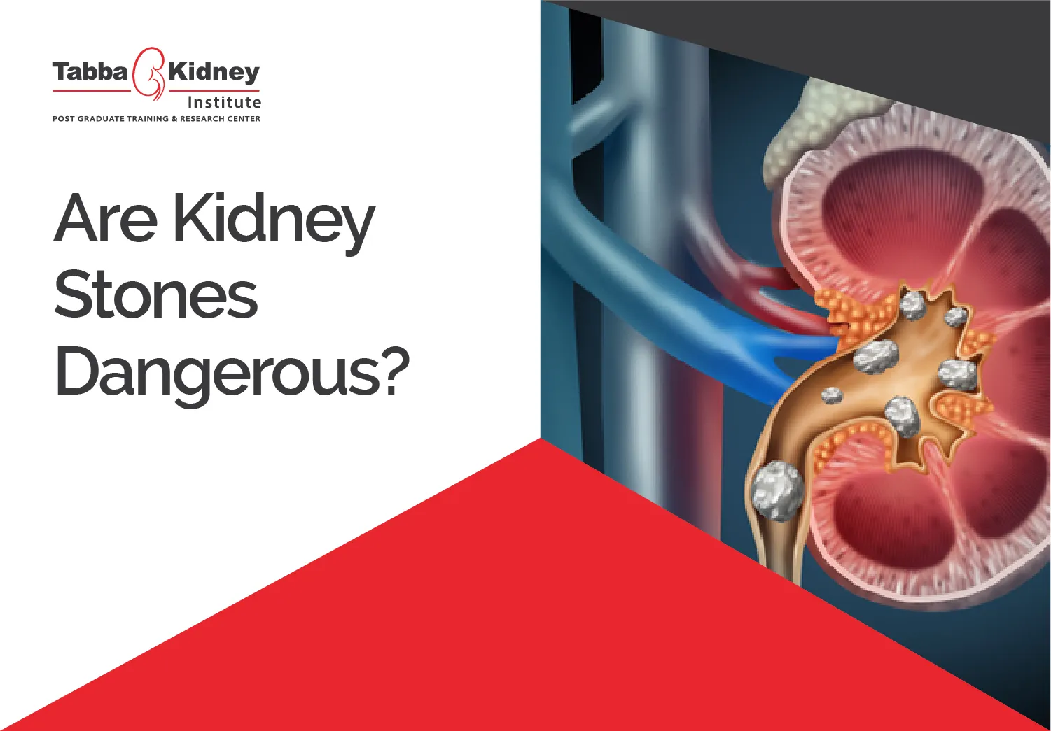 Are Kidney Stones Dangerous