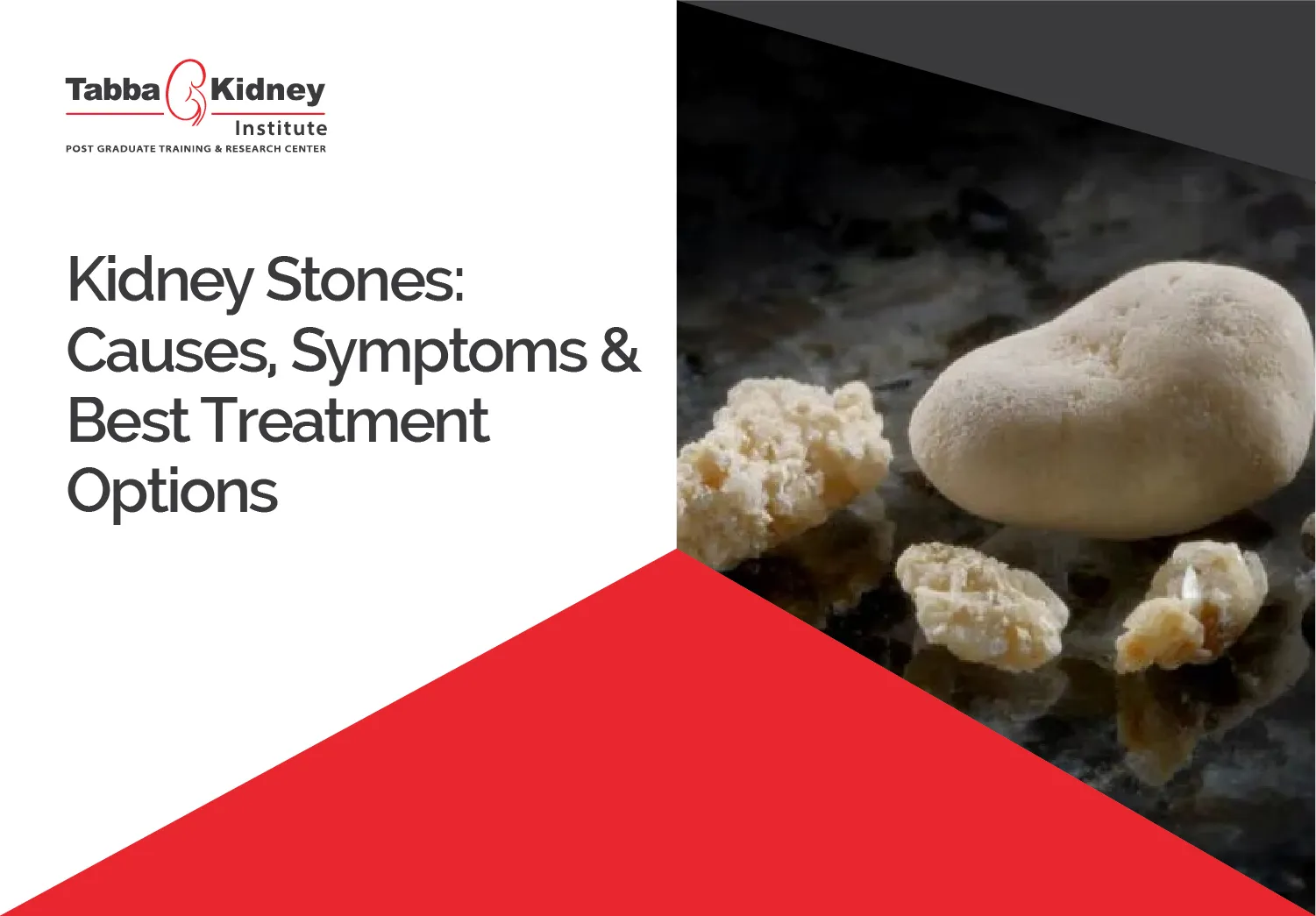 Kidney-Stones